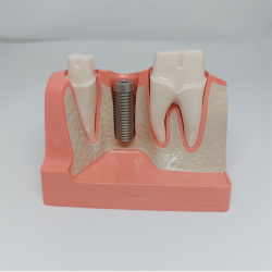 Maxi Implantat/Bro Studiemodel 